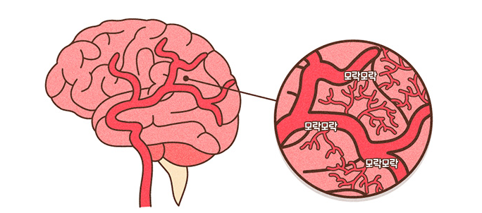 모야모야병이란?
