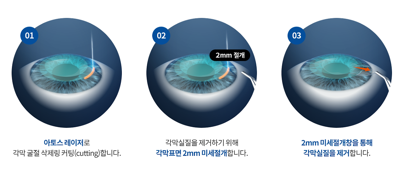 스마일 라식 종류, 비용 알아보기